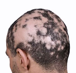 Alopesi Saçkıran Medikal Protez Çözümü